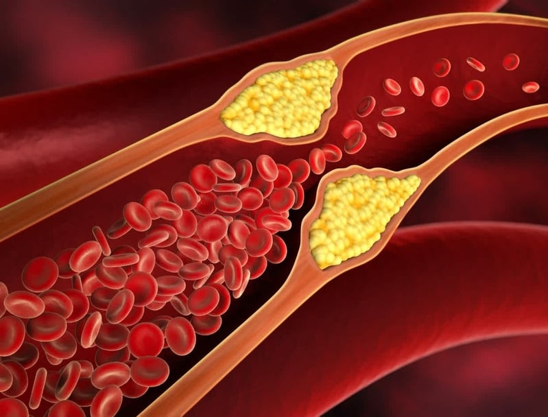 Dobrý vs. zlý cholesterol - Ako na zdravé hodnoty a prevenciu komplikácií.