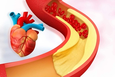 Dobrý vs. zlý cholesterol - Ako na zdravé hodnoty a prevenciu komplikácií.