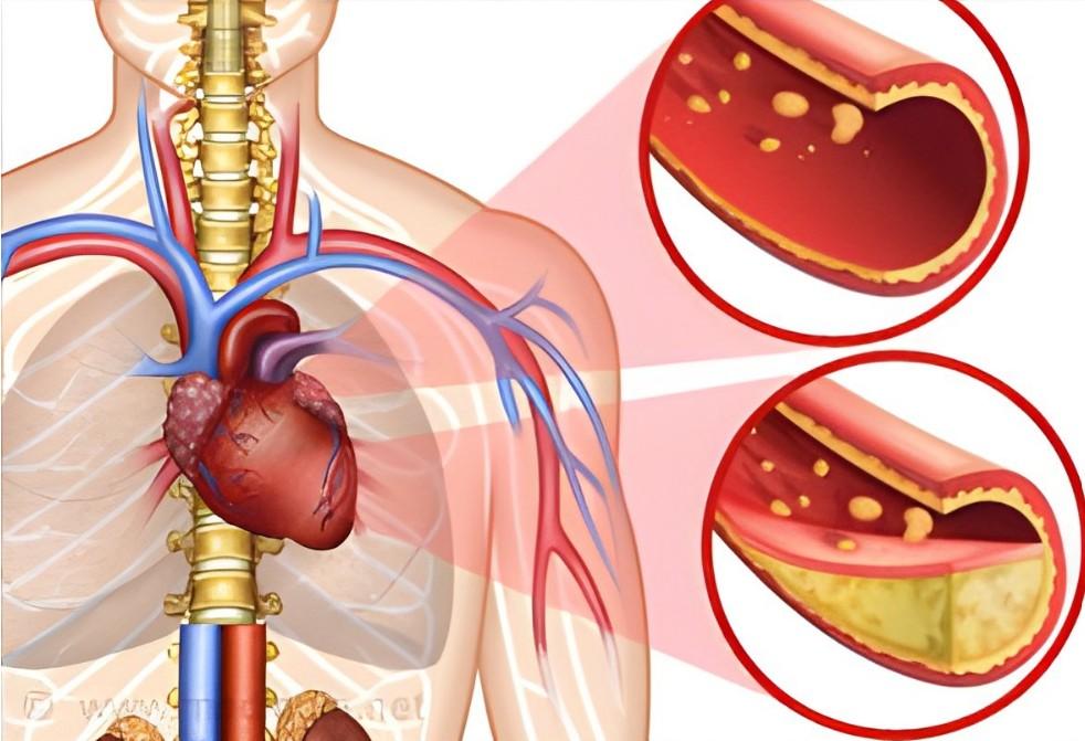 zlý cholesterol